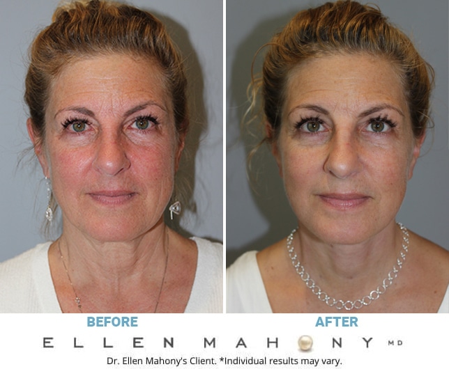 Before and After Image: Case #11214 - front