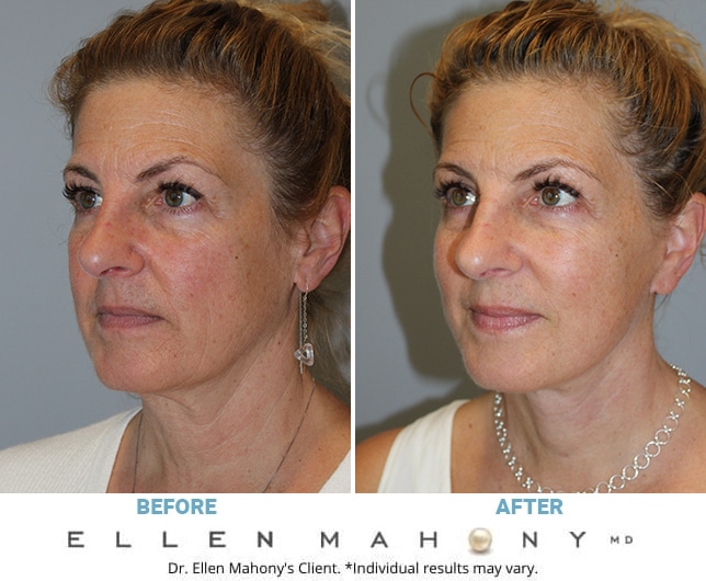 Before and After Image: Case #11214 - left-front-oblique
