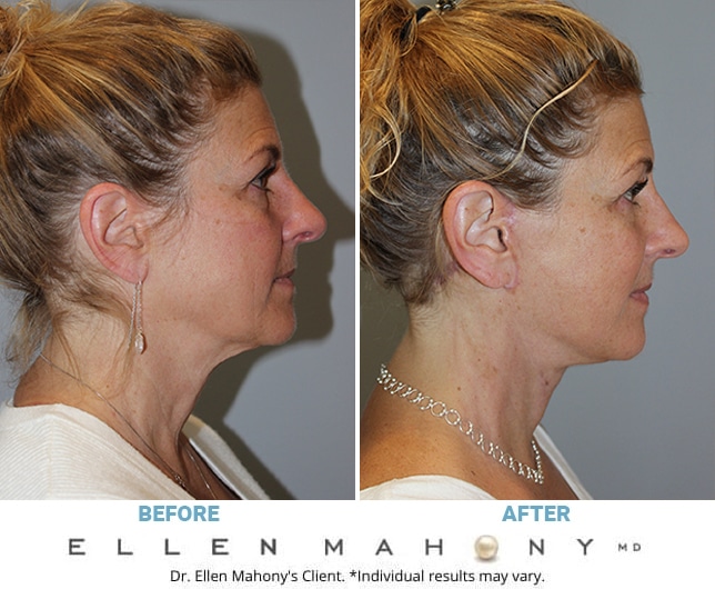 Before and After Image: Case #11214 - right-side