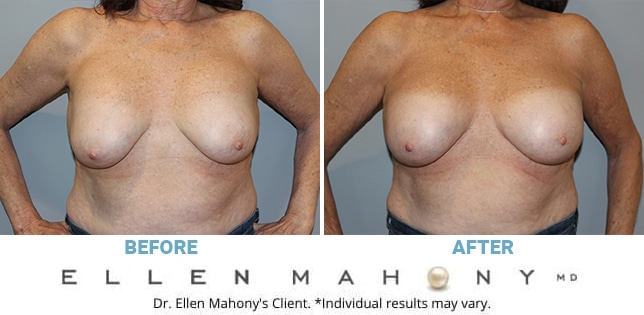 Before and After Image: Case #11341 - front