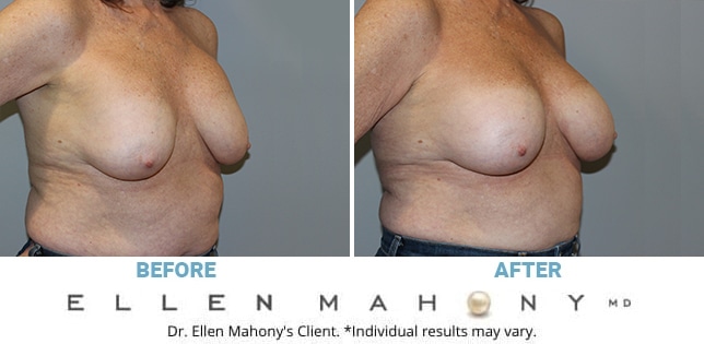 Before and After Image: Case #11341 - right-front-oblique