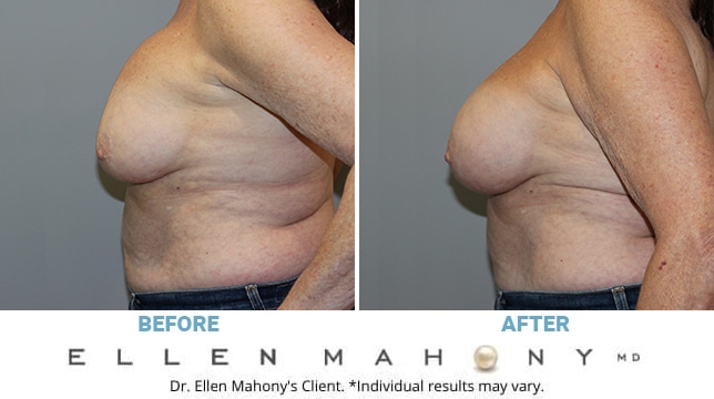 Before and After Image: Case #11341 - left-side
