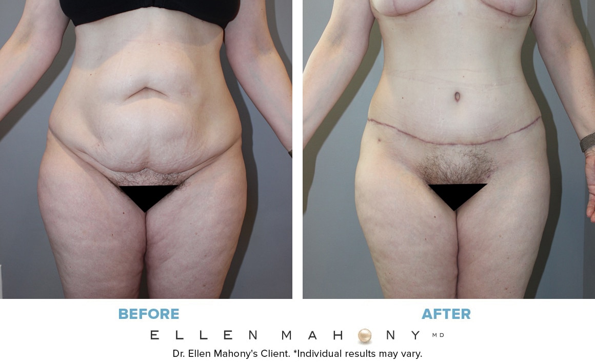Before and After Image: Case #13364 - front