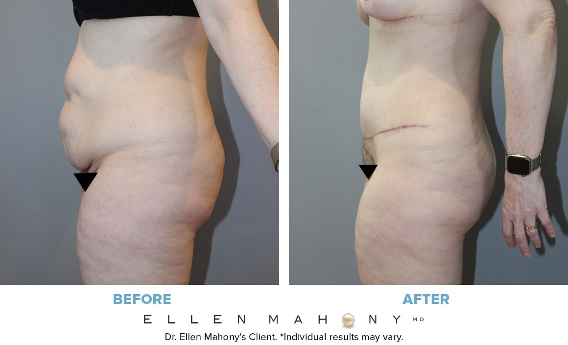 Before and After Image: Case #13364 - left-side