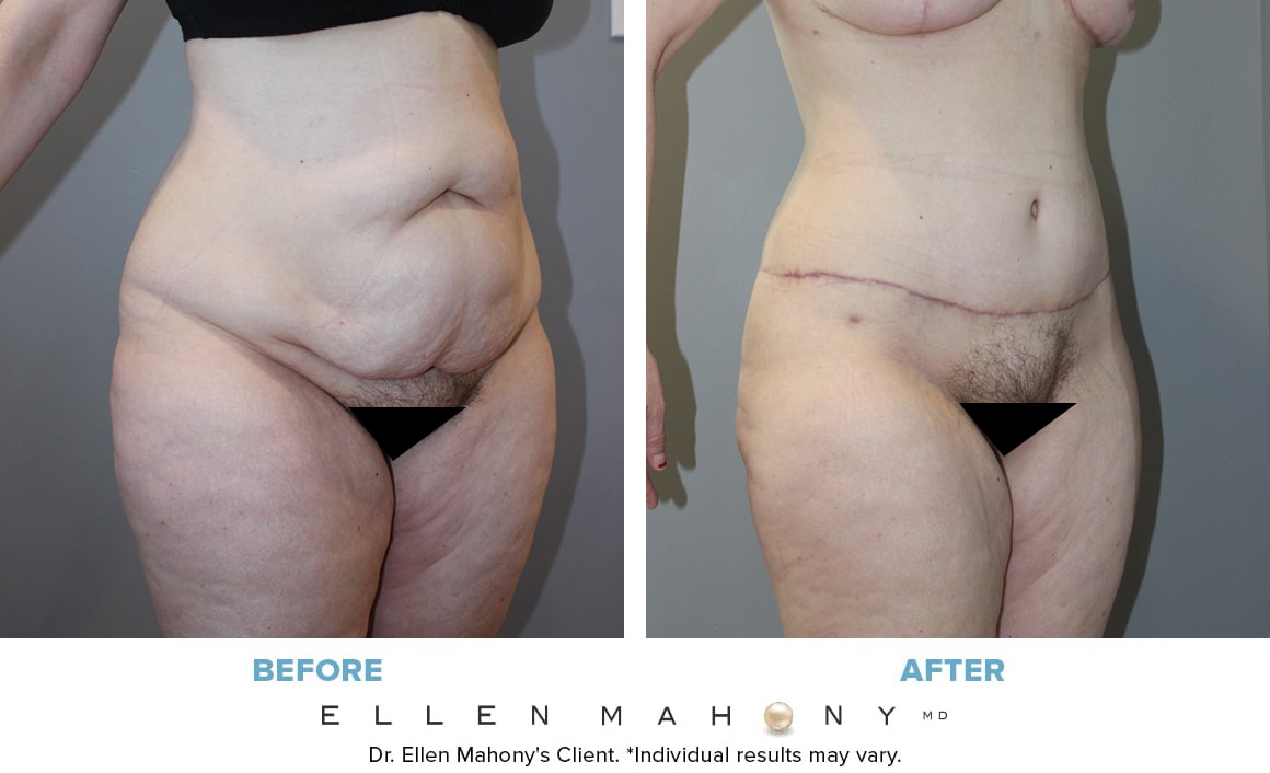 Before and After Image: Case #13364 - right-front-oblique