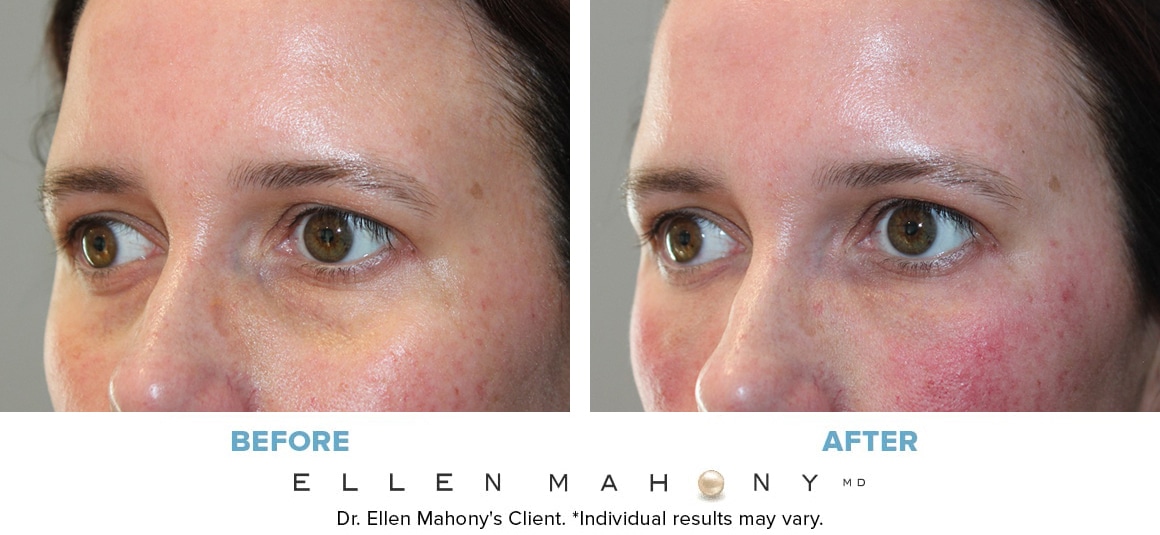 Before and After Image: Case #13690 - left-front-oblique