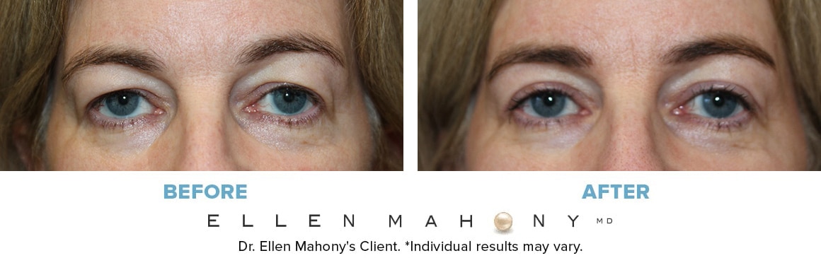 Before and After Image: Case #13933 - front