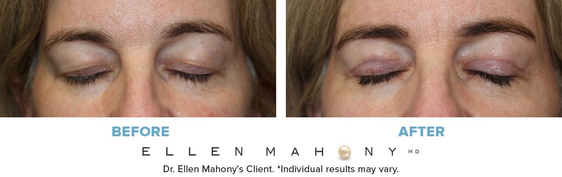 Before and After Image: Case #13933 - front