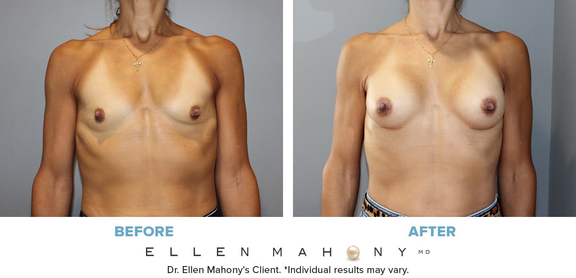 Before and After Image: Case #13971 - front