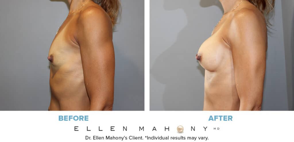 Before and After Image: Case #13971 - left-side