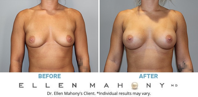 Before and After Image: Case #11392 - front