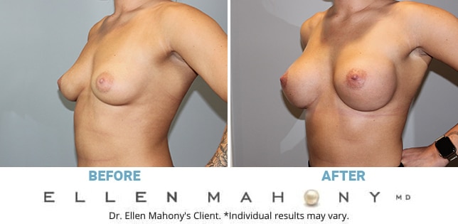 Before and After Image: Case #11392 - left-front-oblique