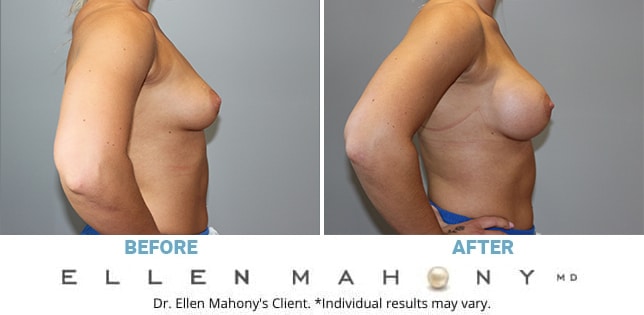 Before and After Image: Case #11392 - right-side