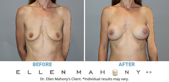 Before and After Image: Case #11439 - front