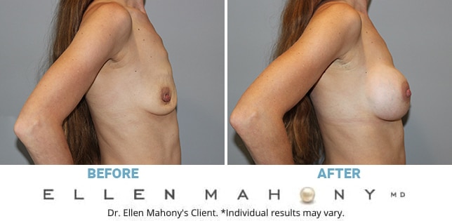 Before and After Image: Case #11439 - right-side