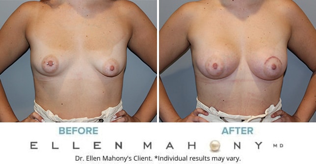 Before and After Image: Case #11125 - front
