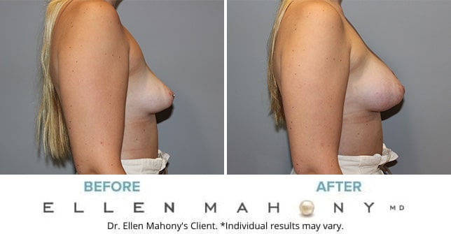 Before and After Image: Case #11125 - right-side