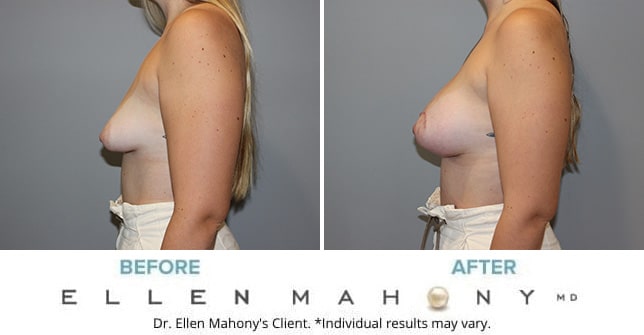 Before and After Image: Case #11125 - left-side