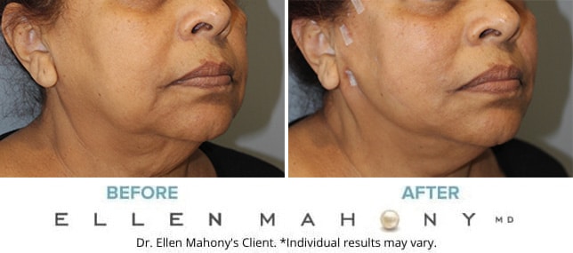 Before and After Image: Case #12045 - front
