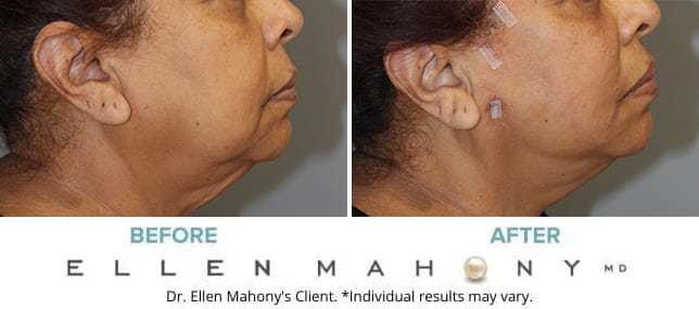 Before and After Image: Case #12045 - right-side