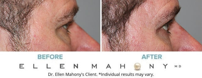 Before and After Image: Case #11515 - right-side