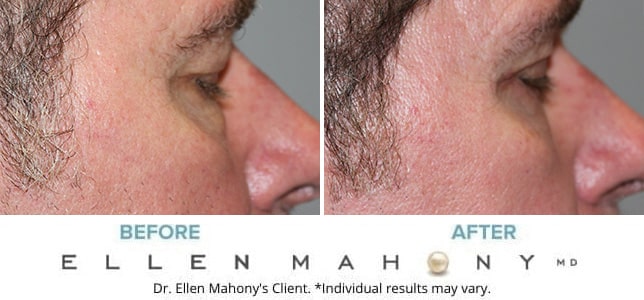 Before and After Image: Case #11515 - right-side