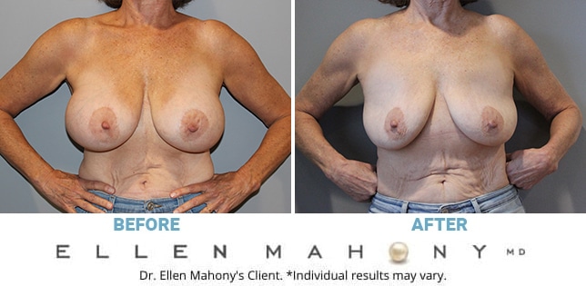 Before and After Image: Case #11574 - front