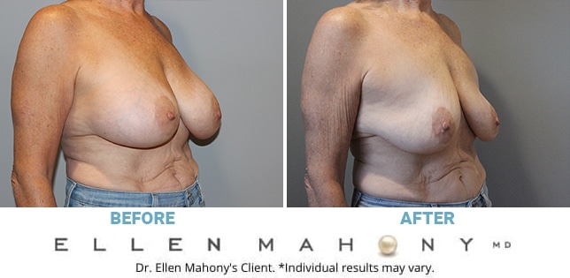 Before and After Image: Case #11574 - right-front-oblique