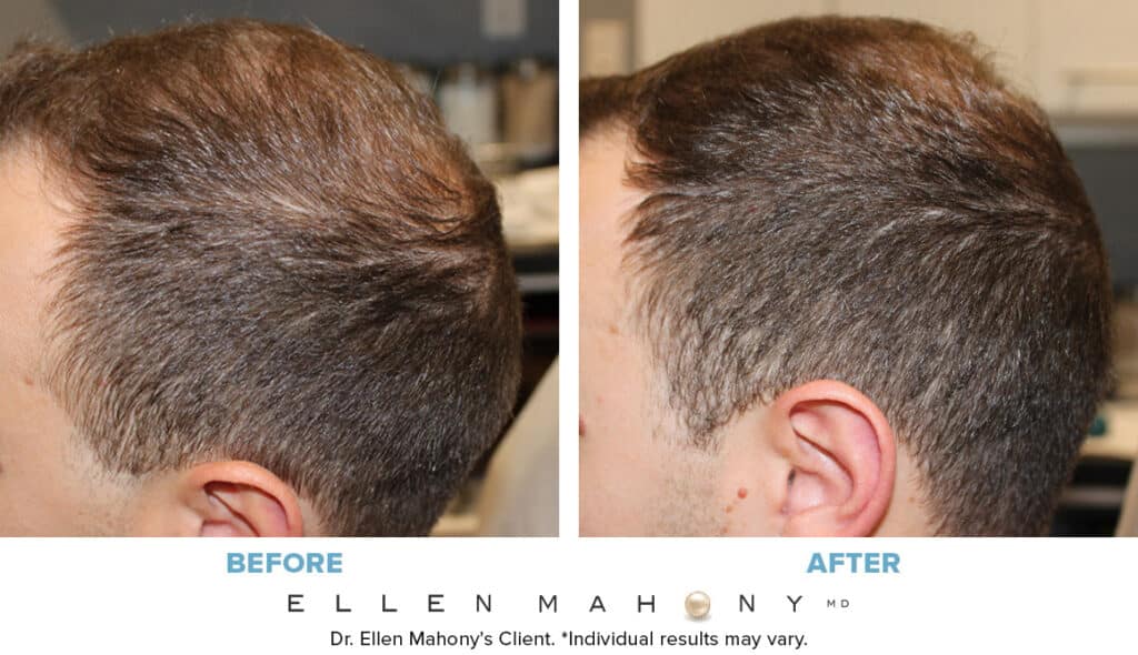 Before and After Image: Case #13761 - left-side
