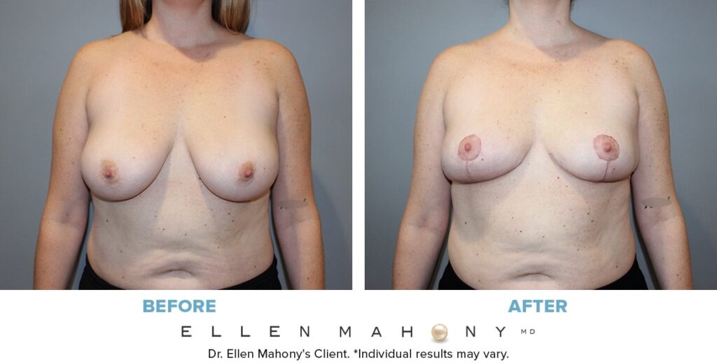 Before and After Image: Case #14000 - front