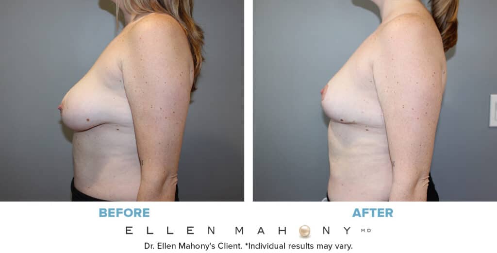 Before and After Image: Case #14000 - left-side