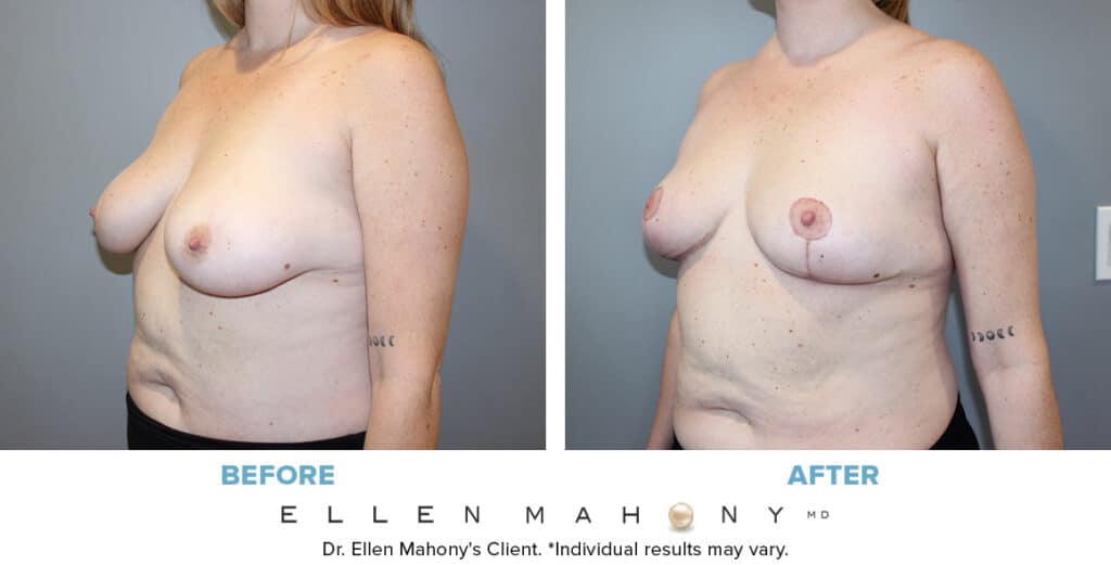 Before and After Image: Case #14000 - left-front-oblique