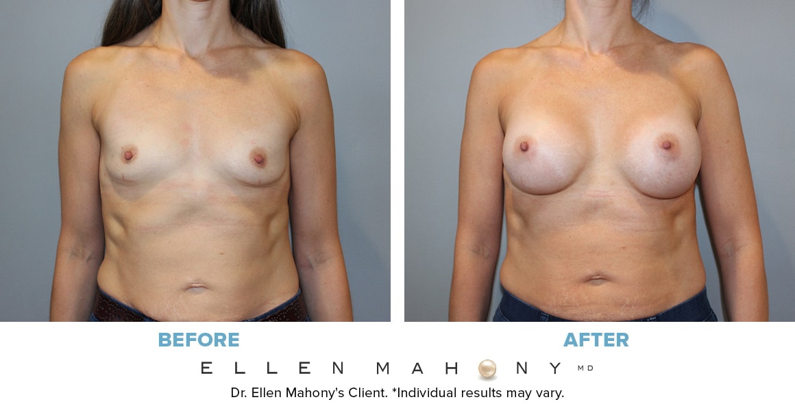 Before and After Image: Case #14068 - front