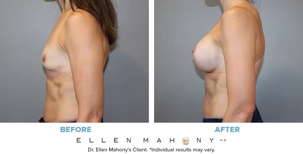 Before and After Image: Case #14068 - left-side