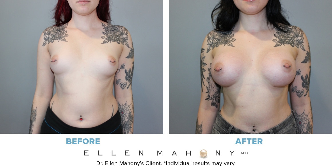 Before and After Image: Case #13520 - front