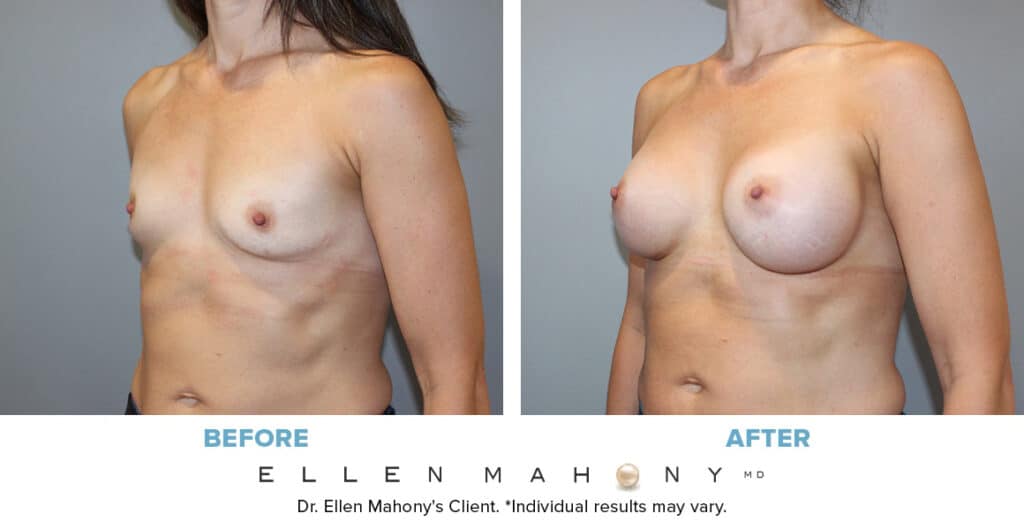 Before and After Image: Case #14068 - left-front-oblique