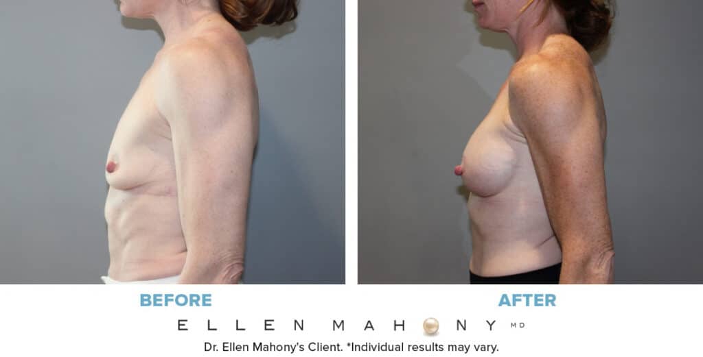 Before and After Image: Case #13678 - left-side