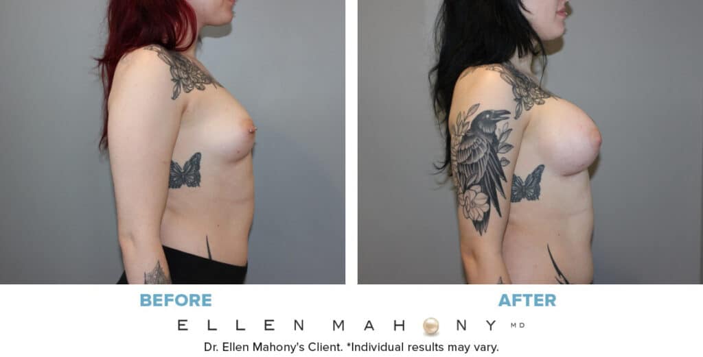 Before and After Image: Case #13520 - right-side