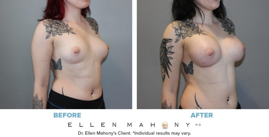 Before and After Image: Case #13520 - right-front-oblique