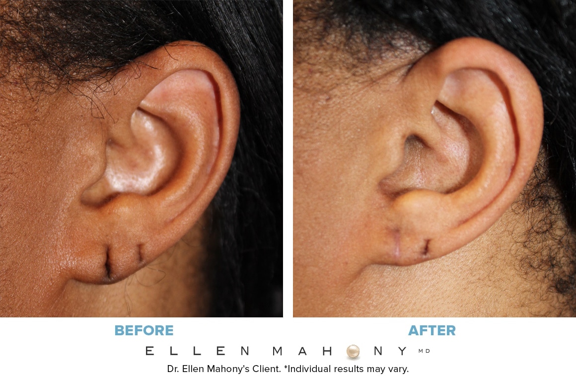 Before and After Image: Case #3627 - left-side