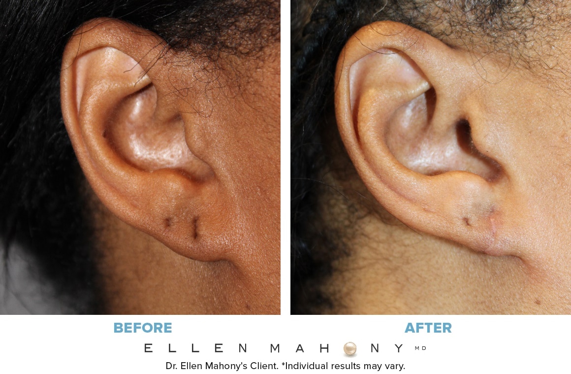 Before and After Image: Case #3627 - right-side
