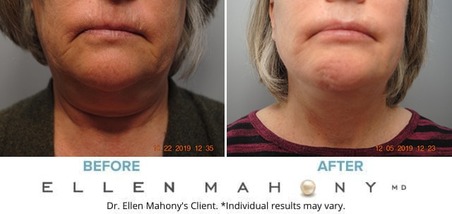 Before and After Image: Case #8565 - front