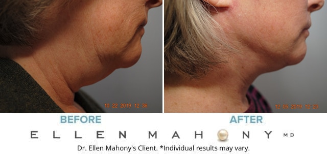 Before and After Image: Case #8565 - right-side
