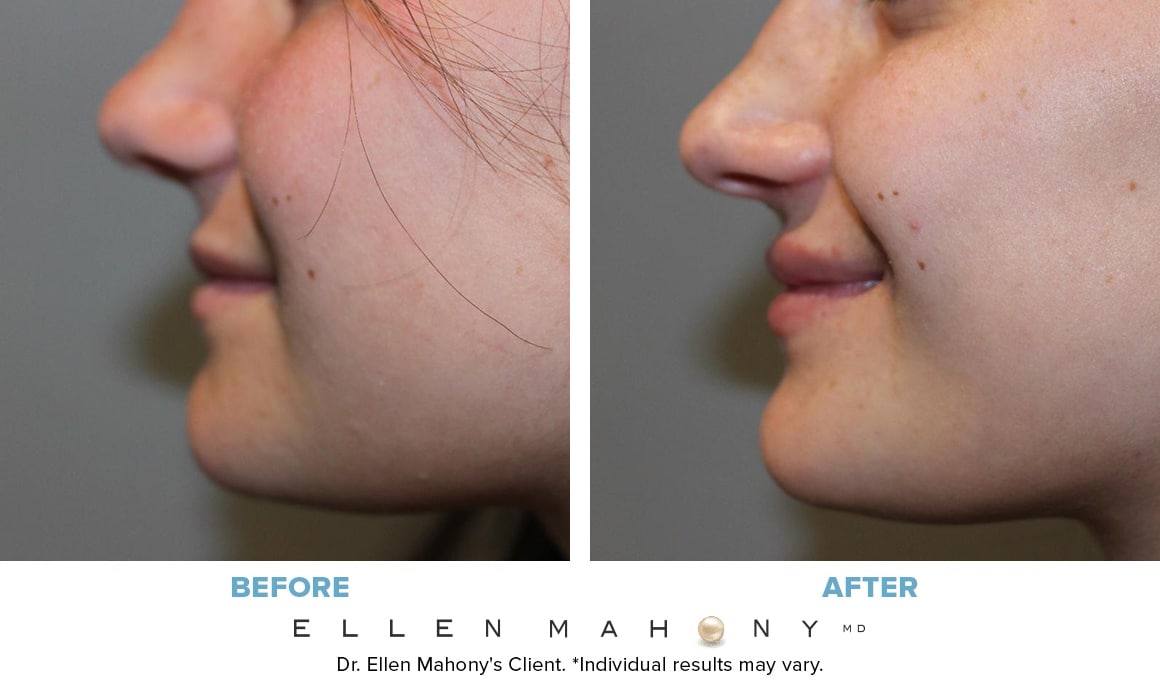 Before and After Image: Case #14031 - left-side