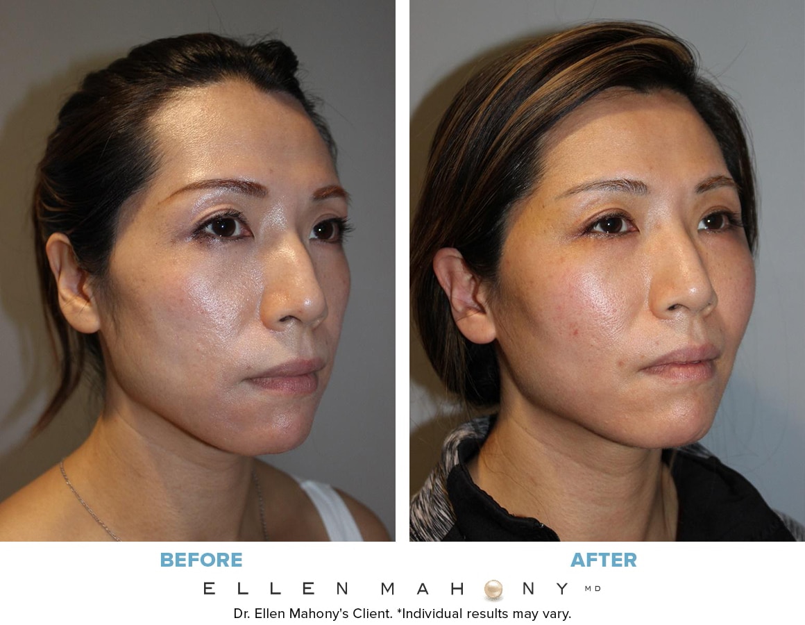 Before and After Image: Case #14129 - right-front-oblique