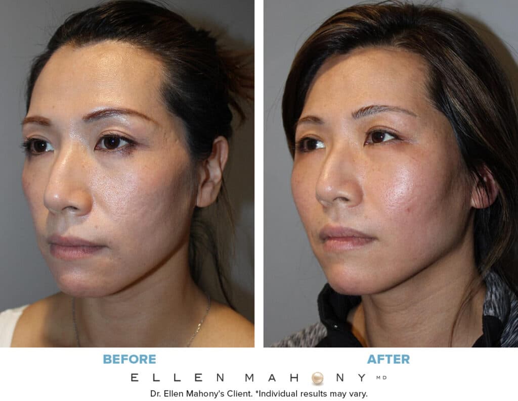 Before and After Image: Case #14129 - left-front-oblique