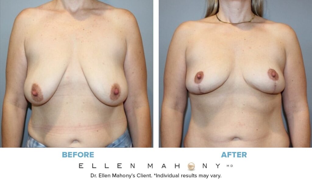 Before and After Image: Case #13836 - front
