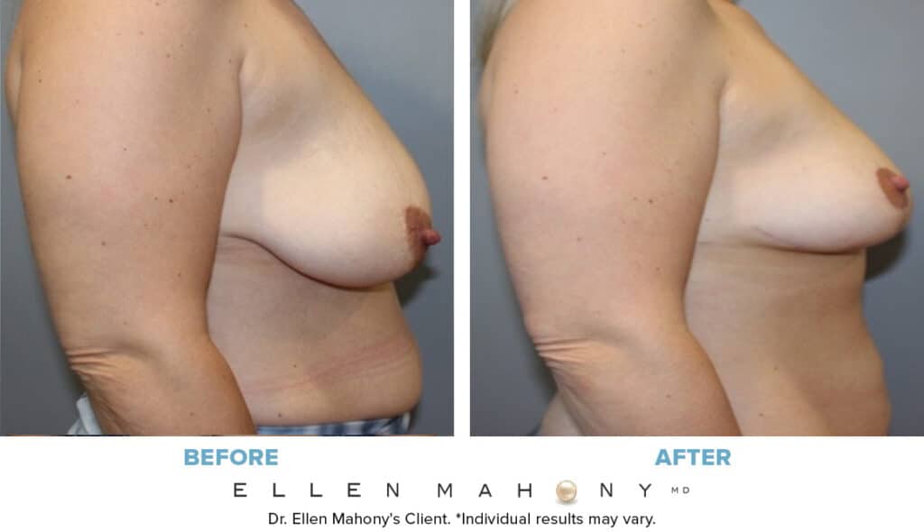 Before and After Image: Case #13836 - right-side
