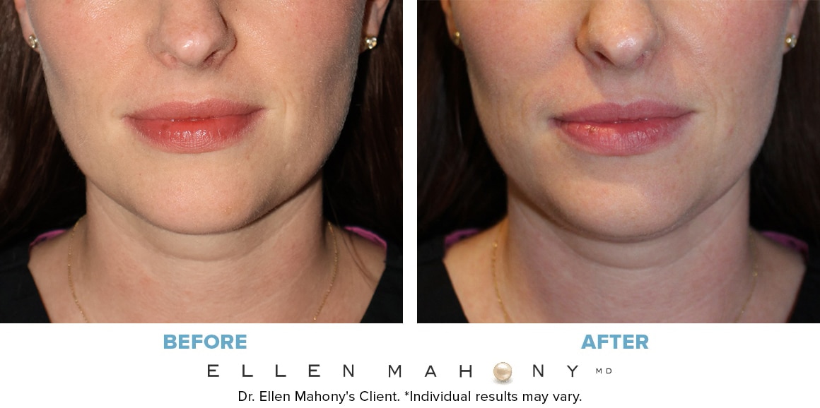 Before and After Image: Case #10179 - front