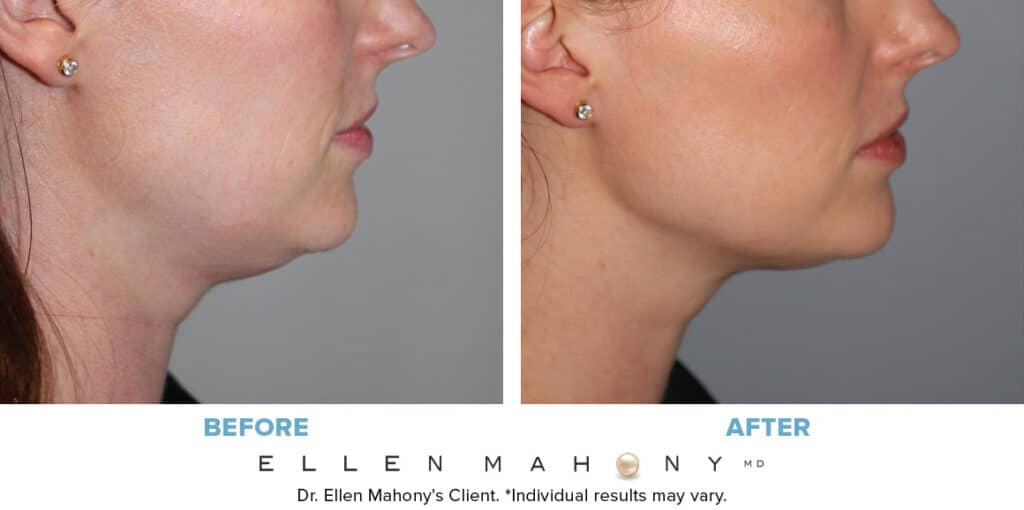Before and After Image: Case #10179 - right-side